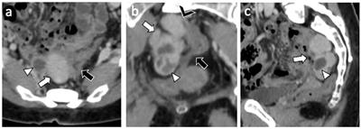 Endomyometriosis of the Rectum With Disseminated Peritoneal Leiomyomatosis 8 Years After Laparoscopic Myomectomy: A Case Report